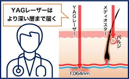 ヤグレーザーはメディオスターと比べてより深い層まで届く