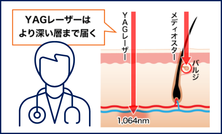ヤグレーザーはメディオスターと比べてより深い層まで届く