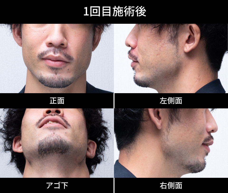 1回目施術後