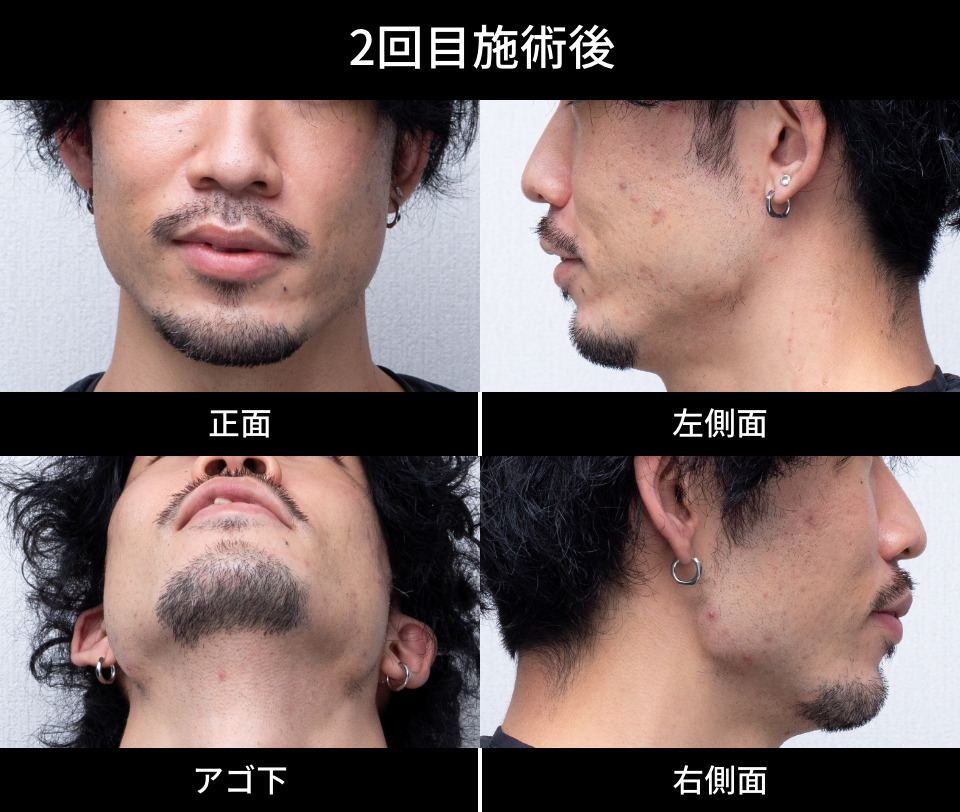 2回目施術後