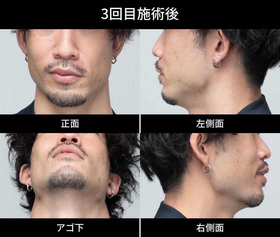 3回目施術後