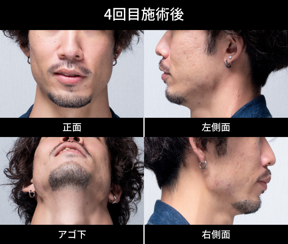 4回目施術後