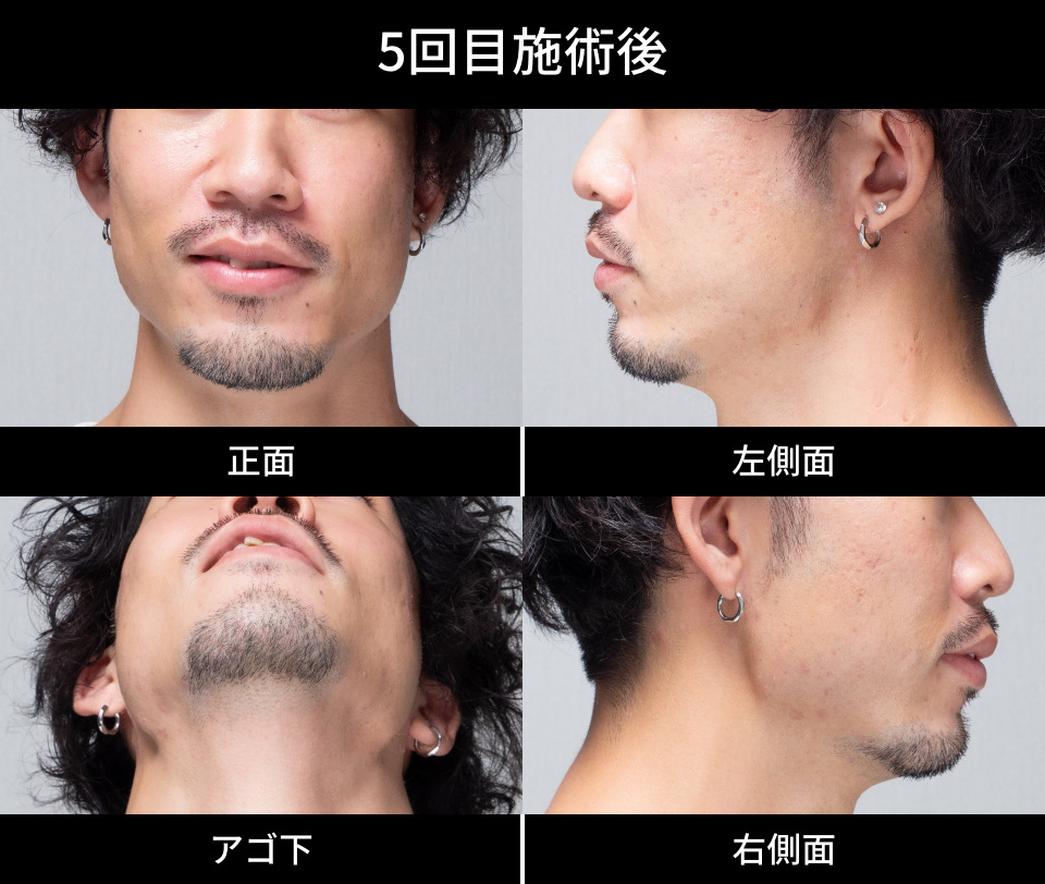 5回目施術後