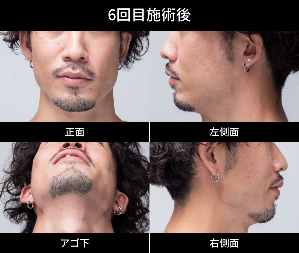 6回目施術後