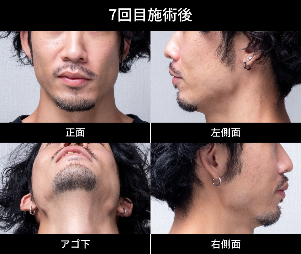 7回目施術後
