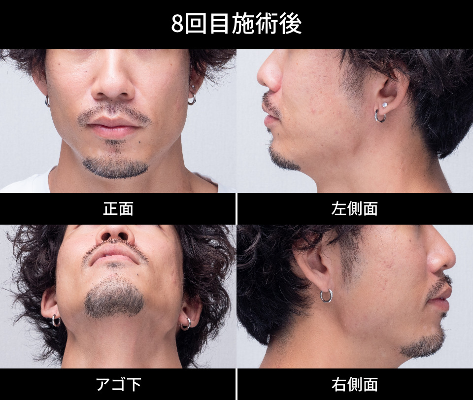 8回目施術後