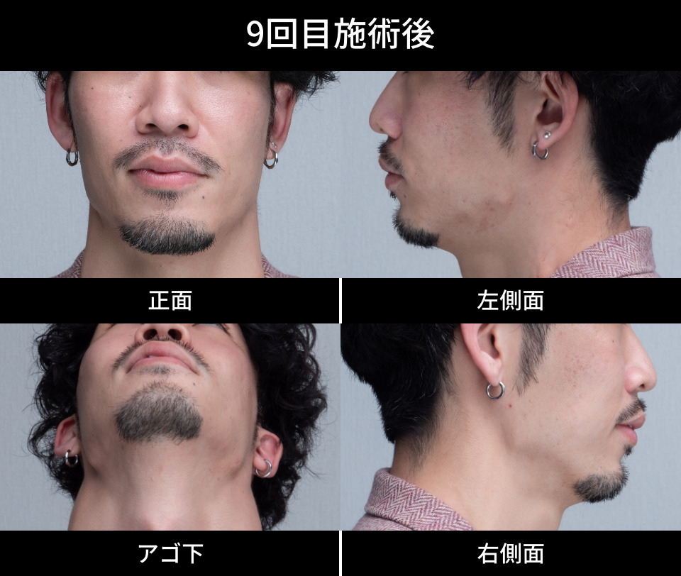 9回目施術後