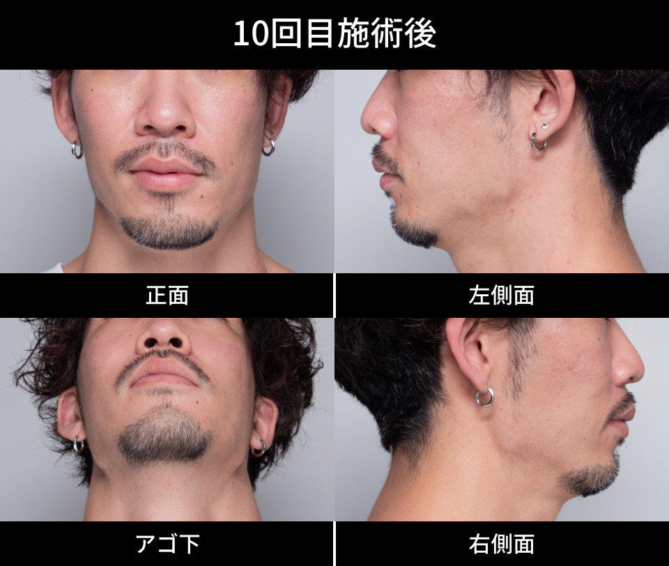 10回目施術後