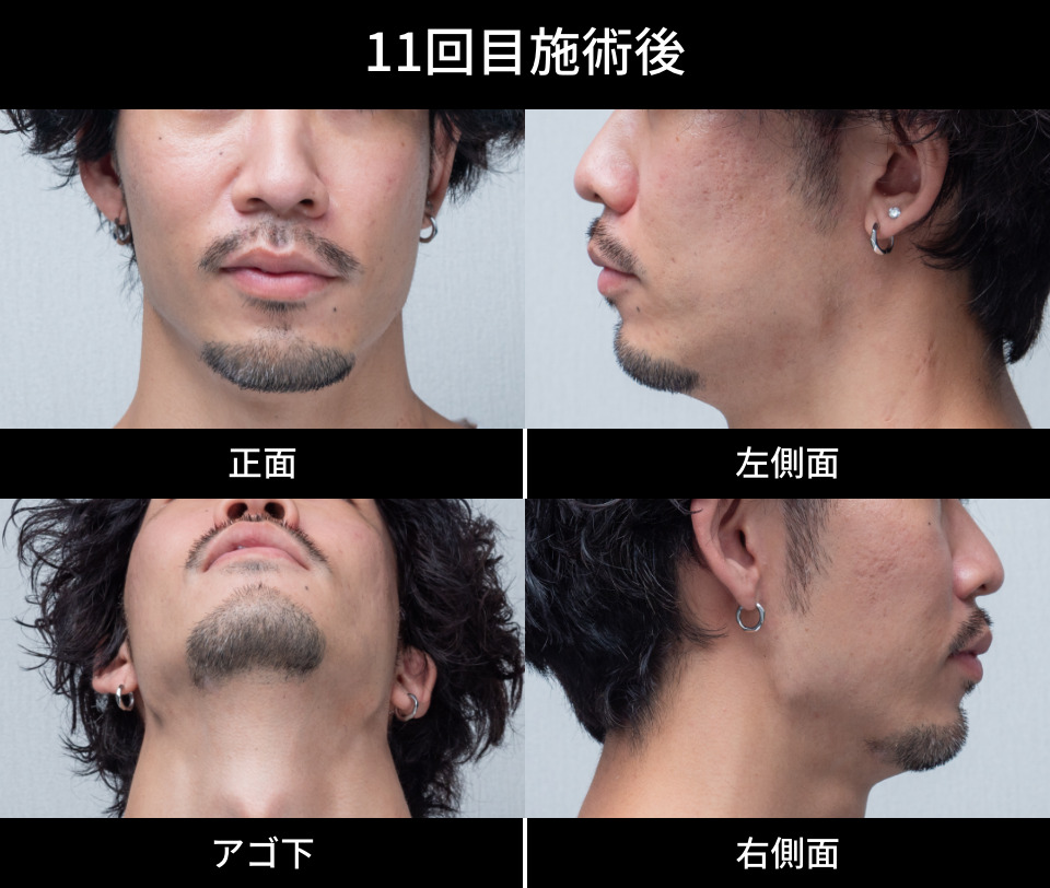 11回目施術後