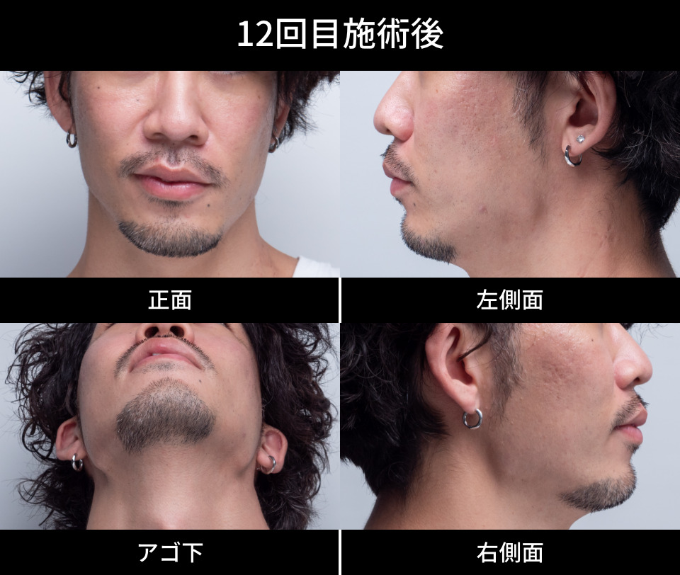 12回目施術後