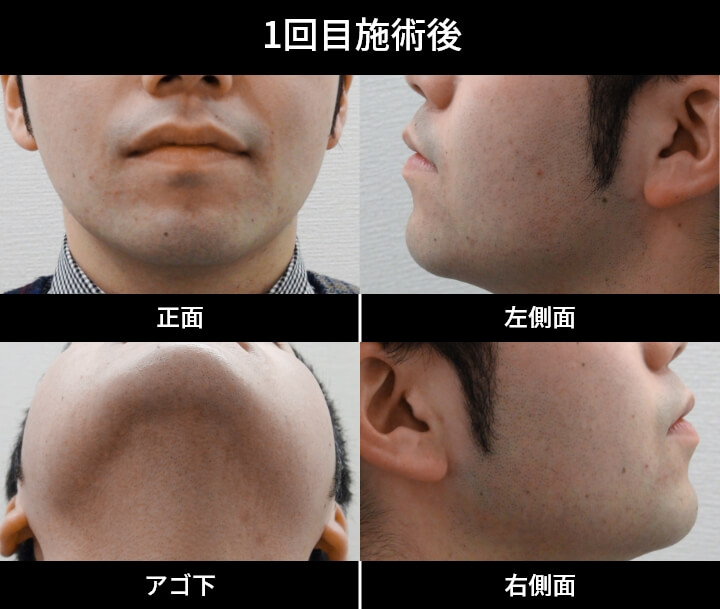 1回目施術後