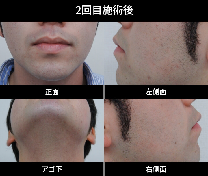 2回目施術後