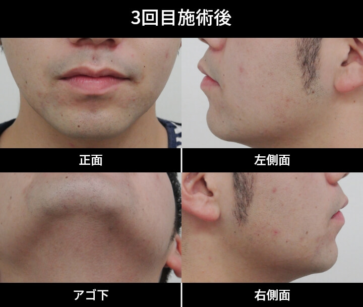 1回目施術後