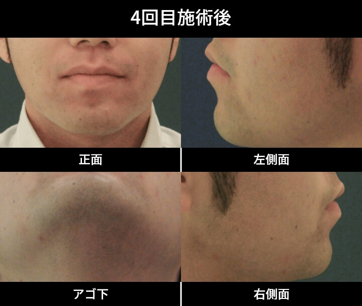 2回目施術後
