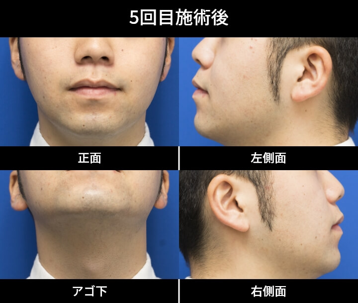 1回目施術後