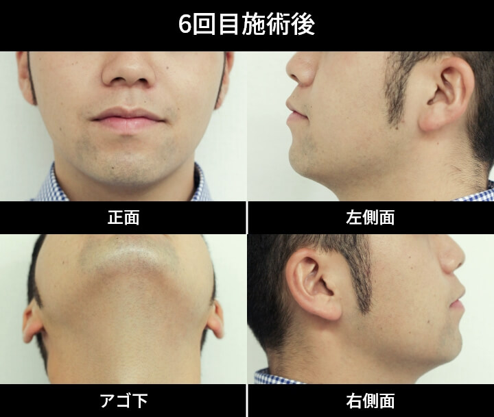 2回目施術後