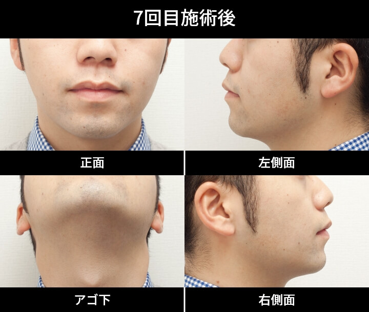 1回目施術後