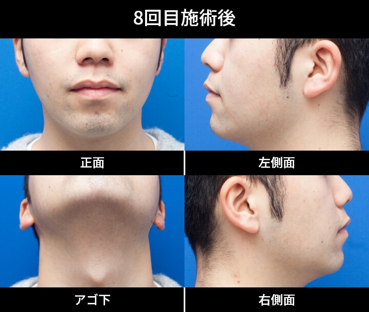 2回目施術後