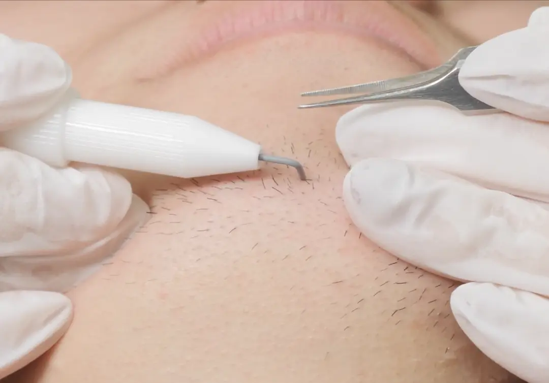 ニードル脱毛