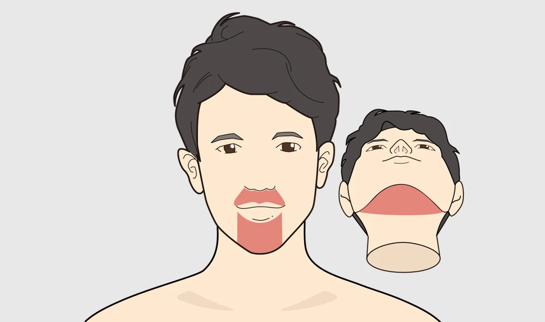 スタートプラン：ヒゲ脱毛３部位