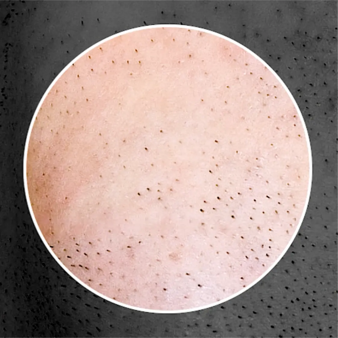 ゴリラクリニック照射パワー