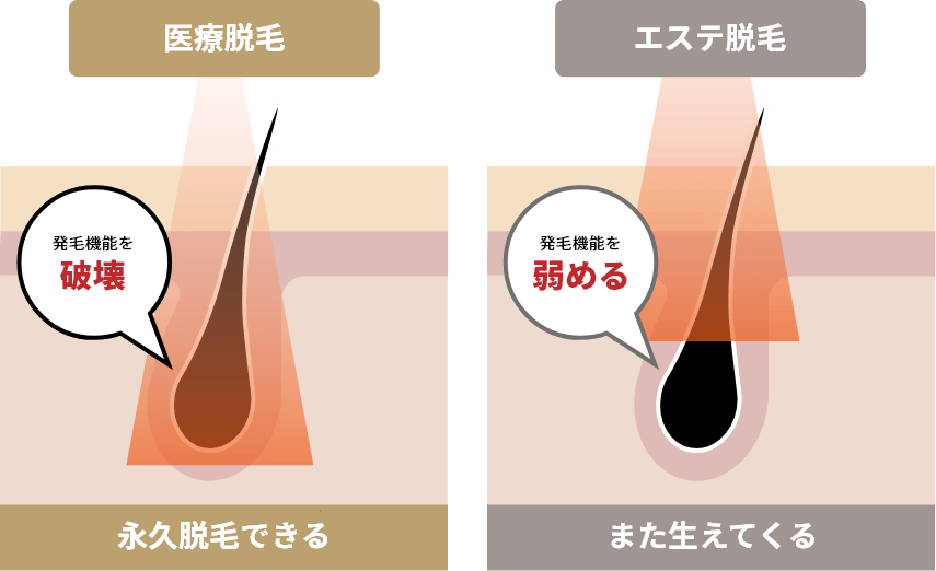 医療脱毛 発毛機能を破壊 永久脱毛できる