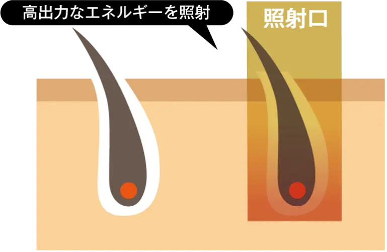 ヤグレーザー ジェントルヤグPRO