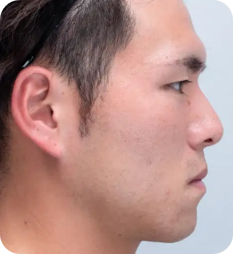 ニキビ治療After