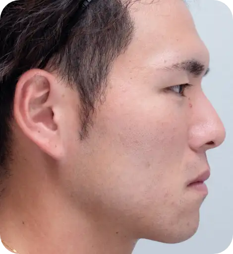 ニキビ治療Before