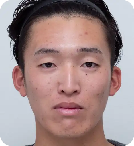 ニキビ治療Before