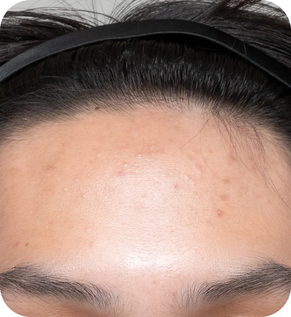 肌トリートメントAfter