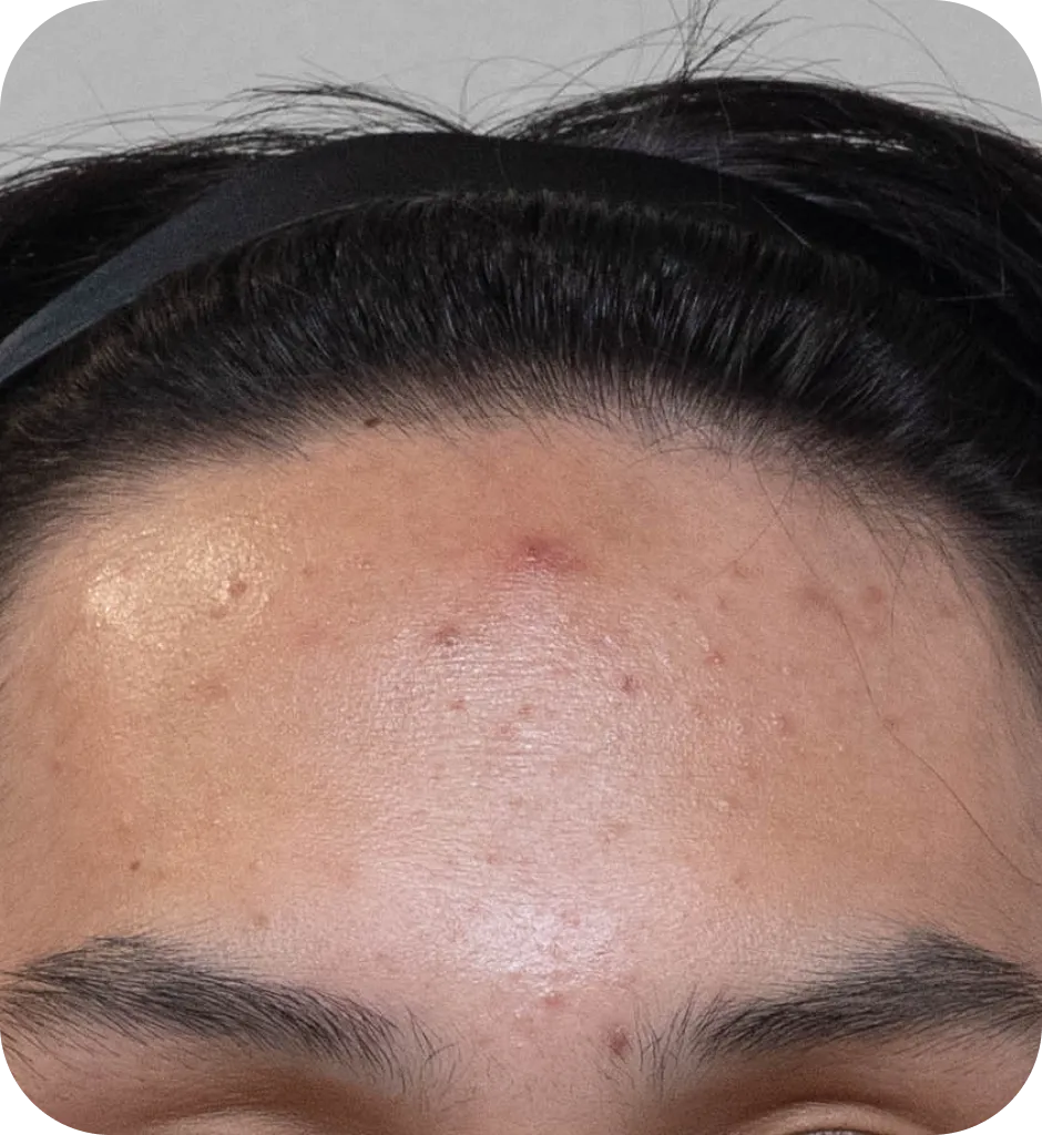 肌トリートメントBefore