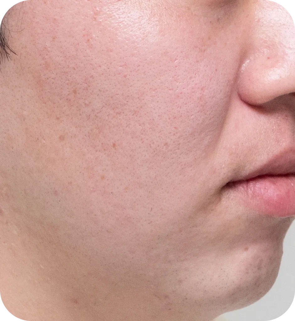 エレクトロポーションAfter