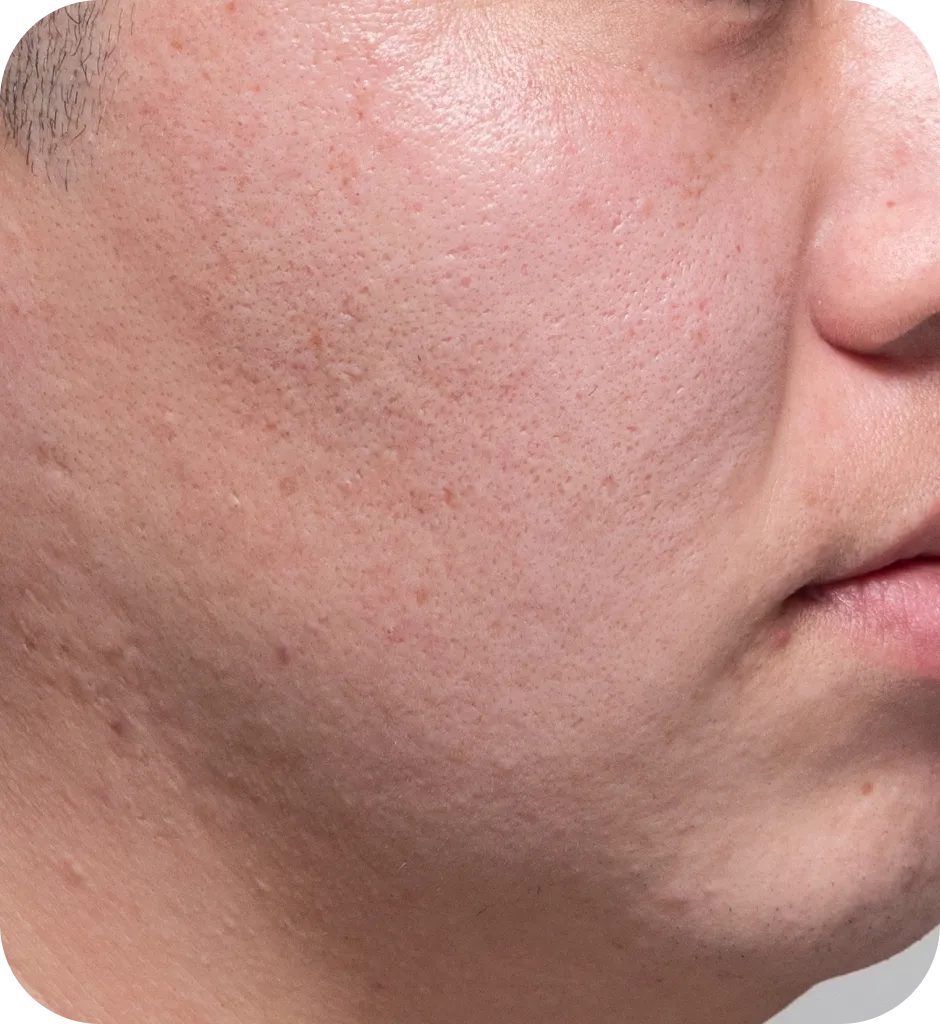 エレクトロポーションBefore