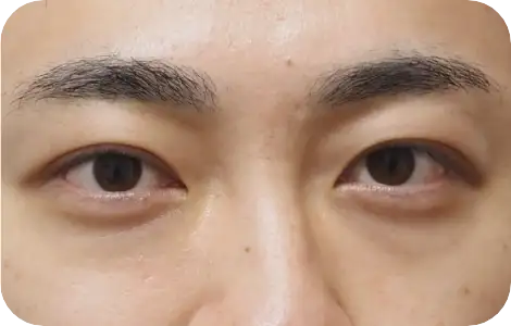目の下の脂肪除去（切らないクマ・たるみ取り）治療After