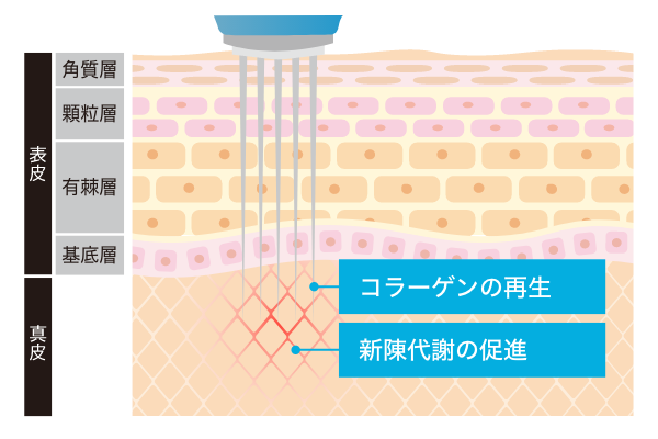 ダーマペン4の効果・仕組み