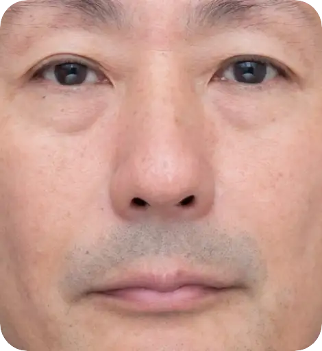 ゴリラシミ治療（ステラM22） After