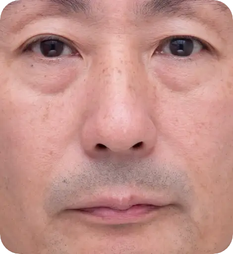 ゴリラシミ治療（ステラM22） Before