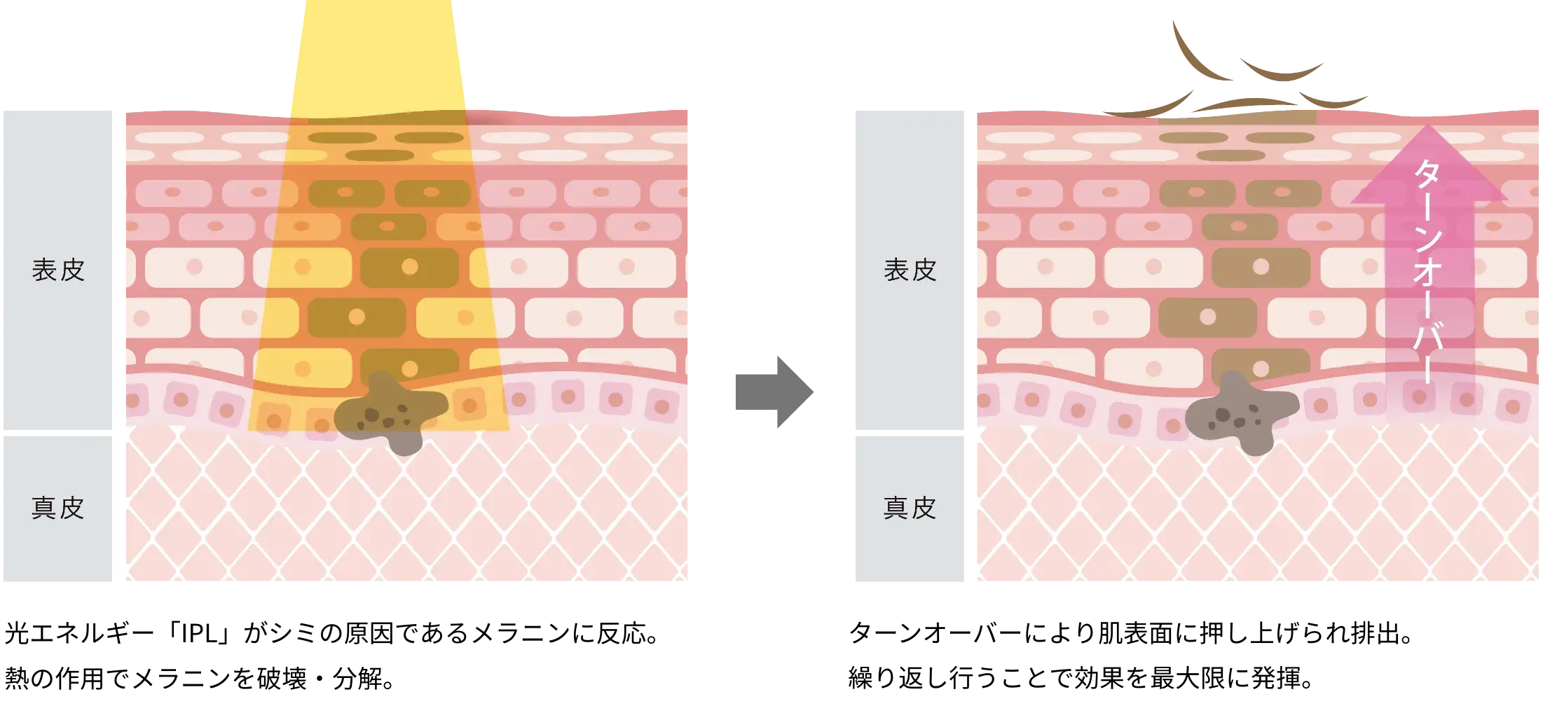ゴリラシミ治療（ステラM22）の効果・仕組み