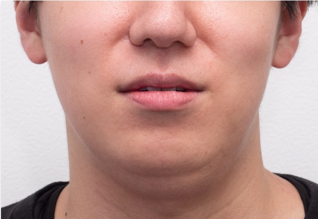 二重アゴ・小顔治療の症例写真