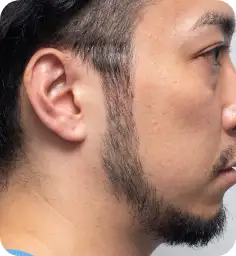 シミそばかす治療:スポットレーザー After