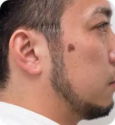 シミそばかす治療:スポットレーザー Before