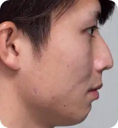 シミそばかす治療:スポットレーザー After