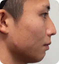 シミそばかす治療:スポットレーザー Before