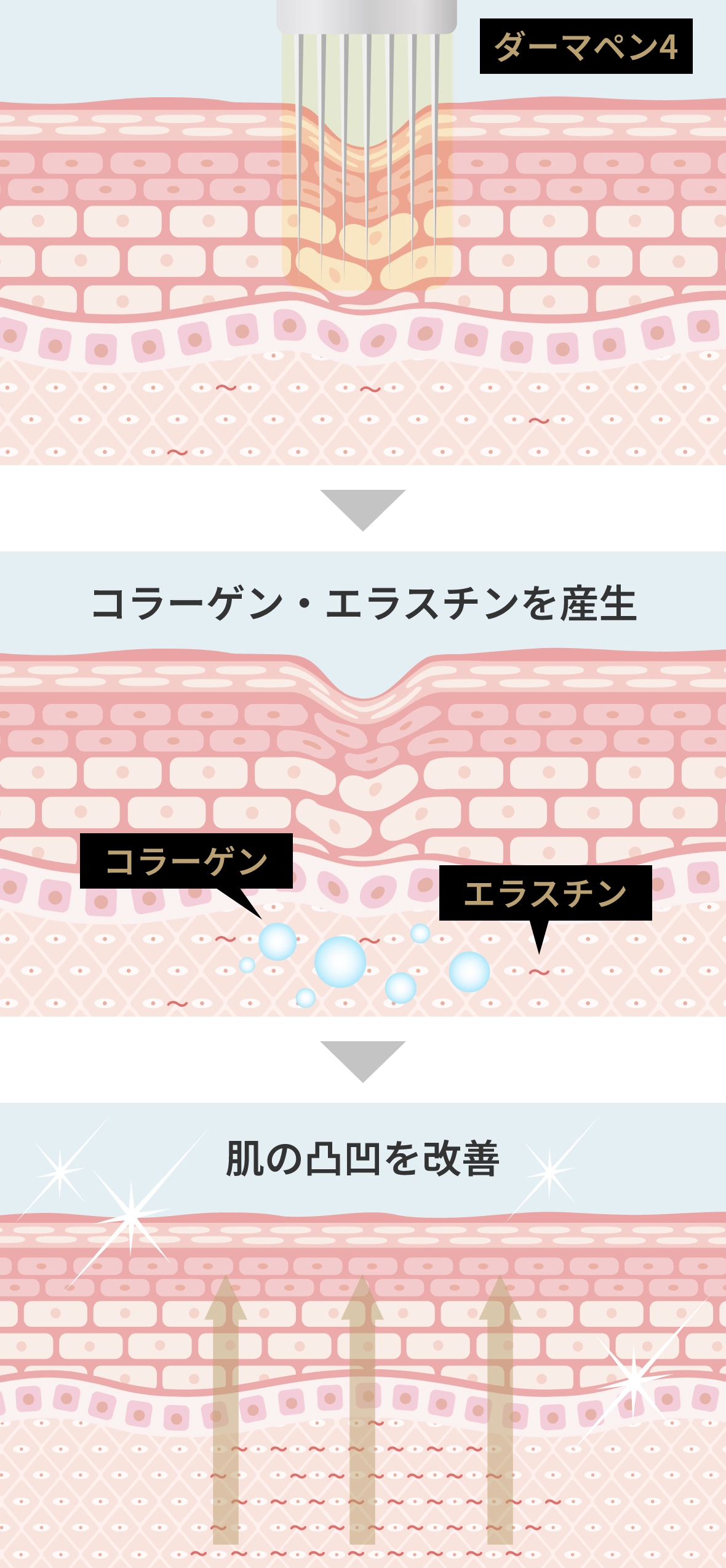 ダーマペン