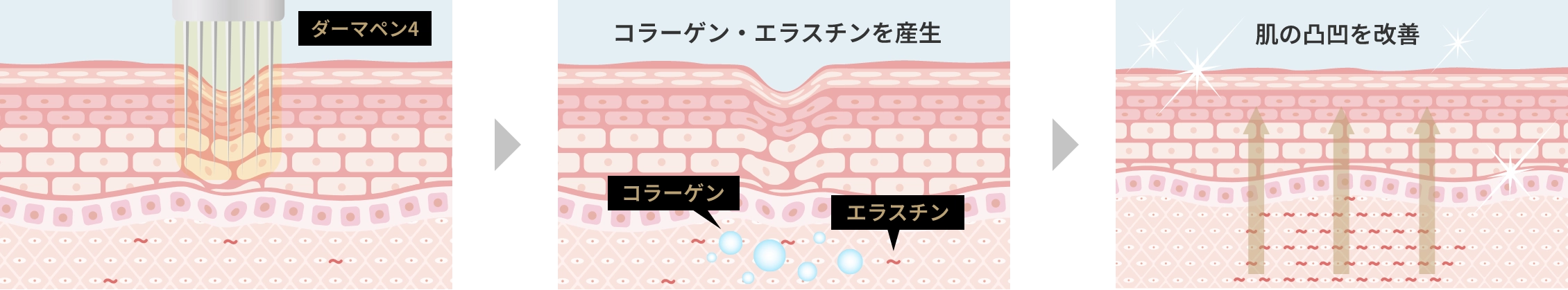 ダーマペン