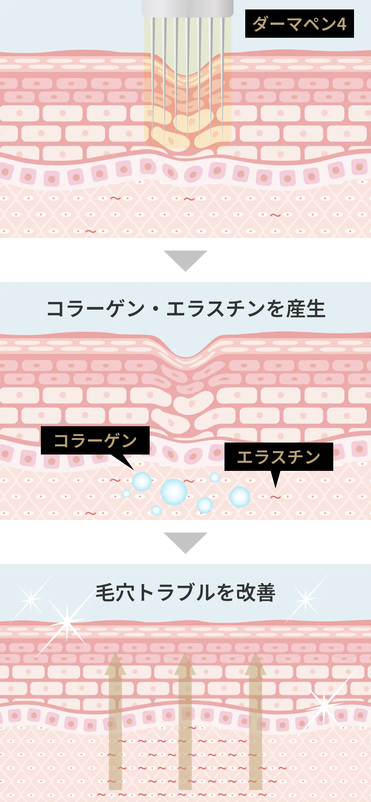 ダーマペン