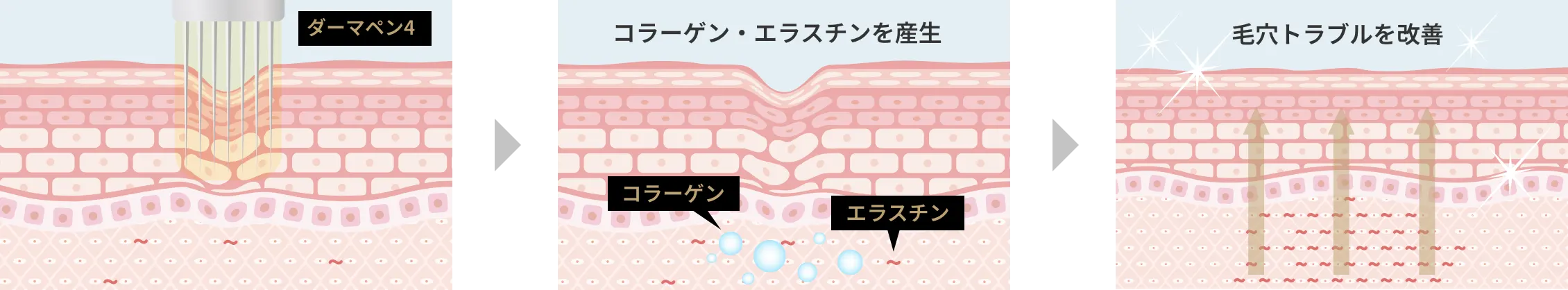 ダーマペン