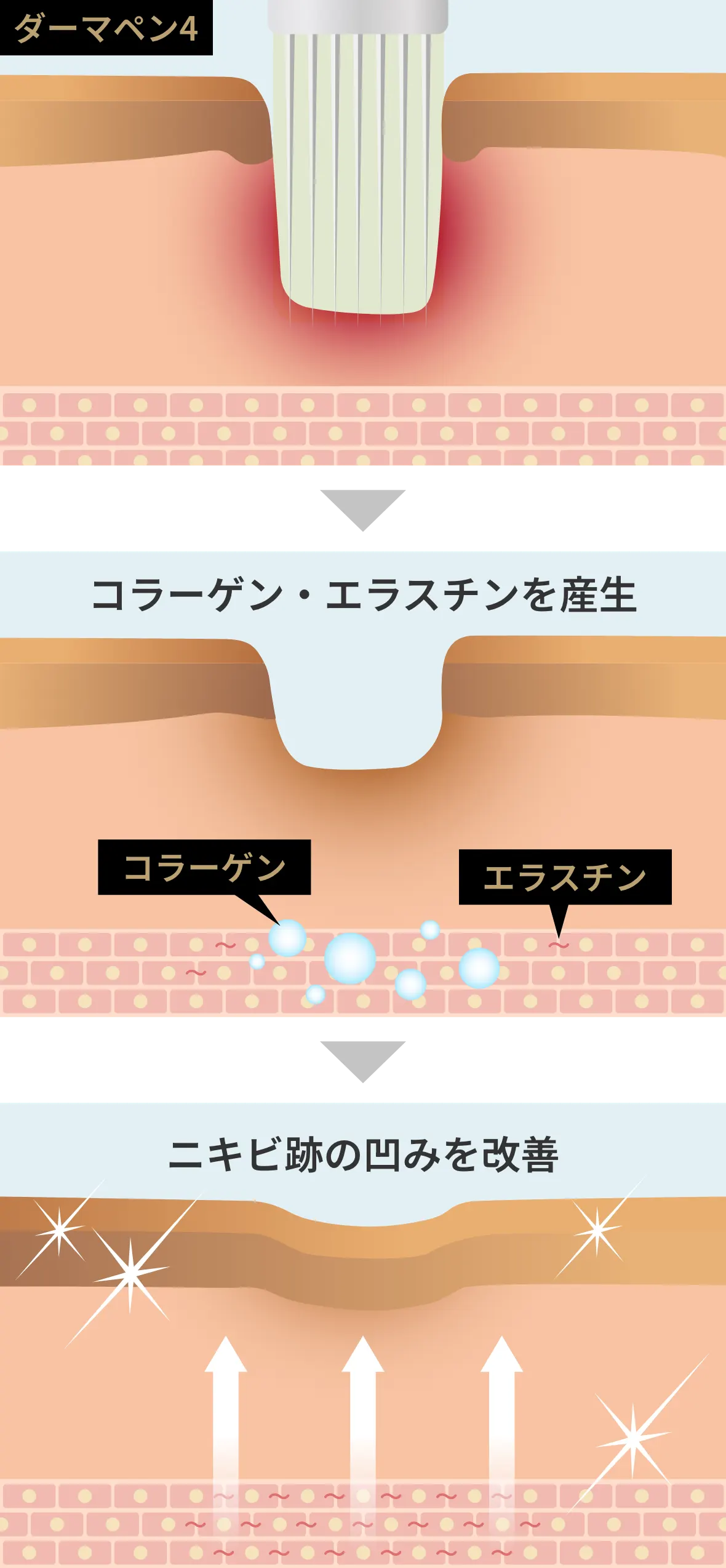 ダーマペン