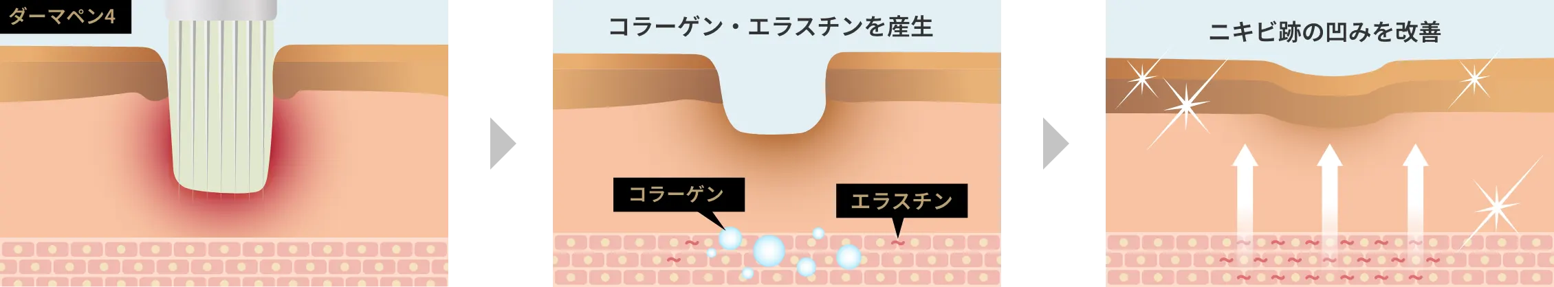 ダーマペン